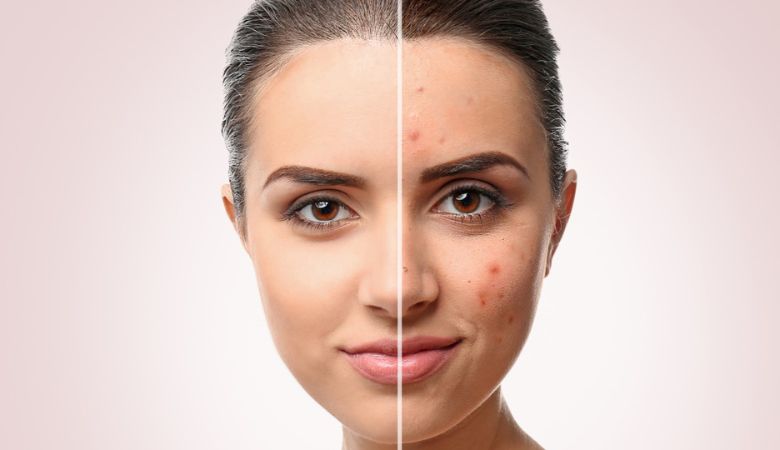 What is The Best Treatment For Acne Scars?